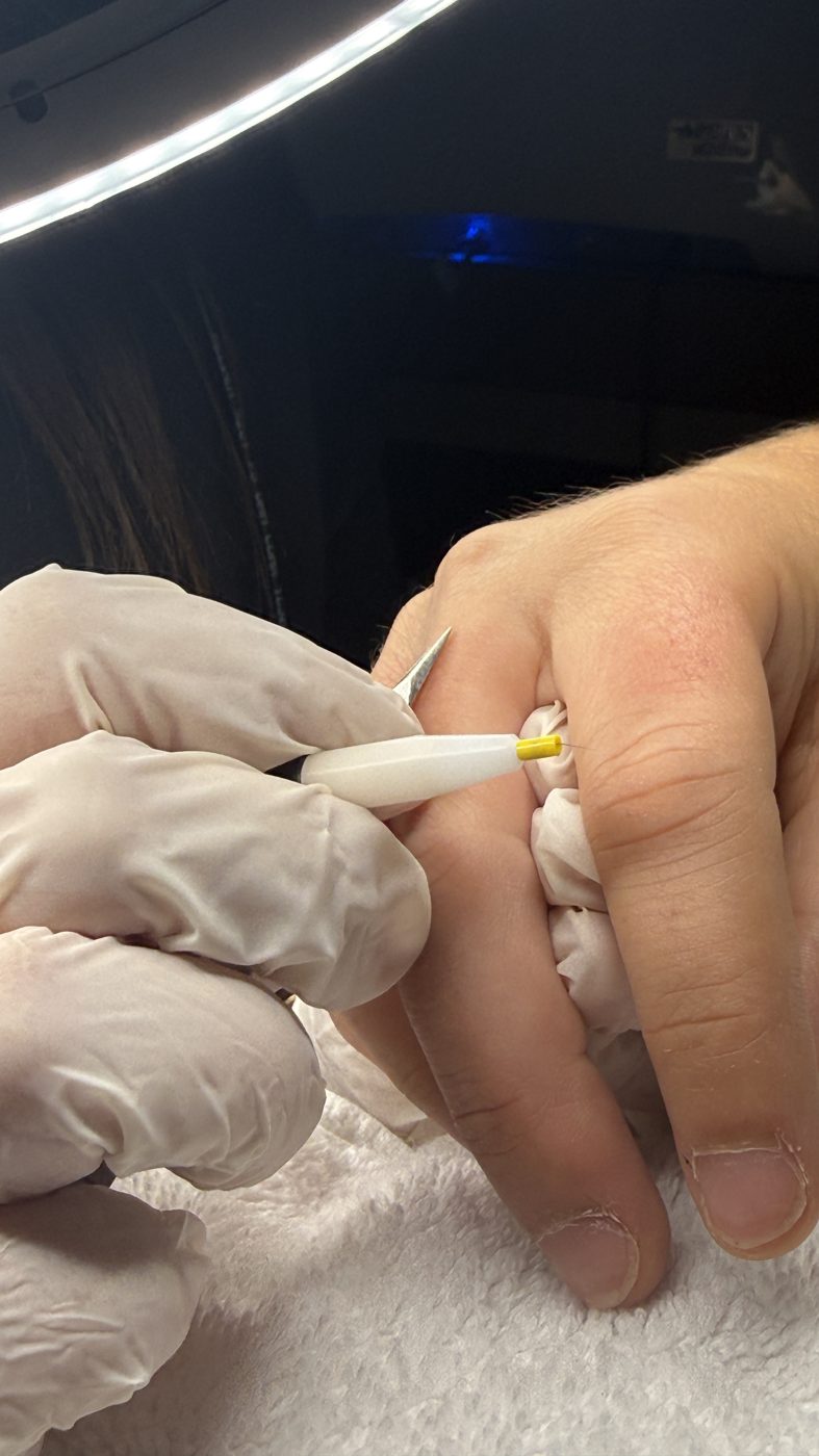 Séance d'électrolyse : stylet Apilus et aiguille posés au plus près du poil