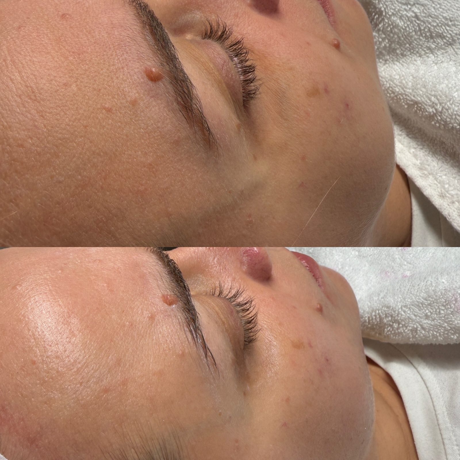 Résultat avant/après d'un soin Hydraskin — contour de l'œil