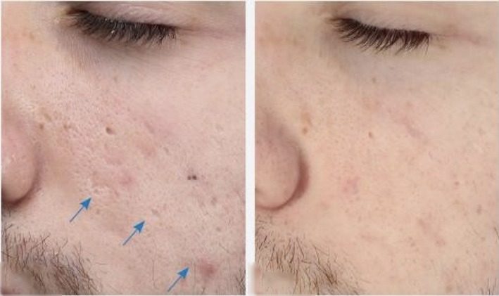 Résultat avant/après microneedling — cicatrices d'acné
